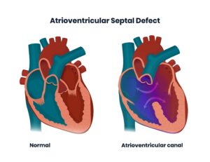 atrioventricular septal defect