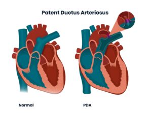 patent ductus arteriosus