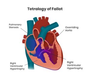 tetralogy of fallot