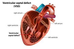 ventricular septal defect