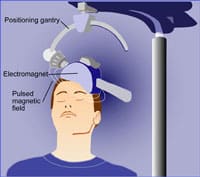 artist depiction of repetitive transcranial magnetic stimulation