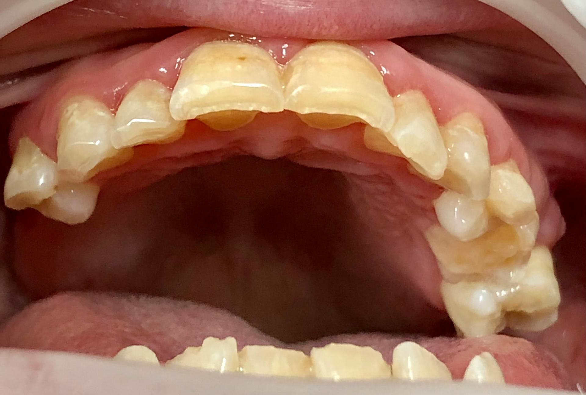 Figure 1: Katie has signs of bruxism.