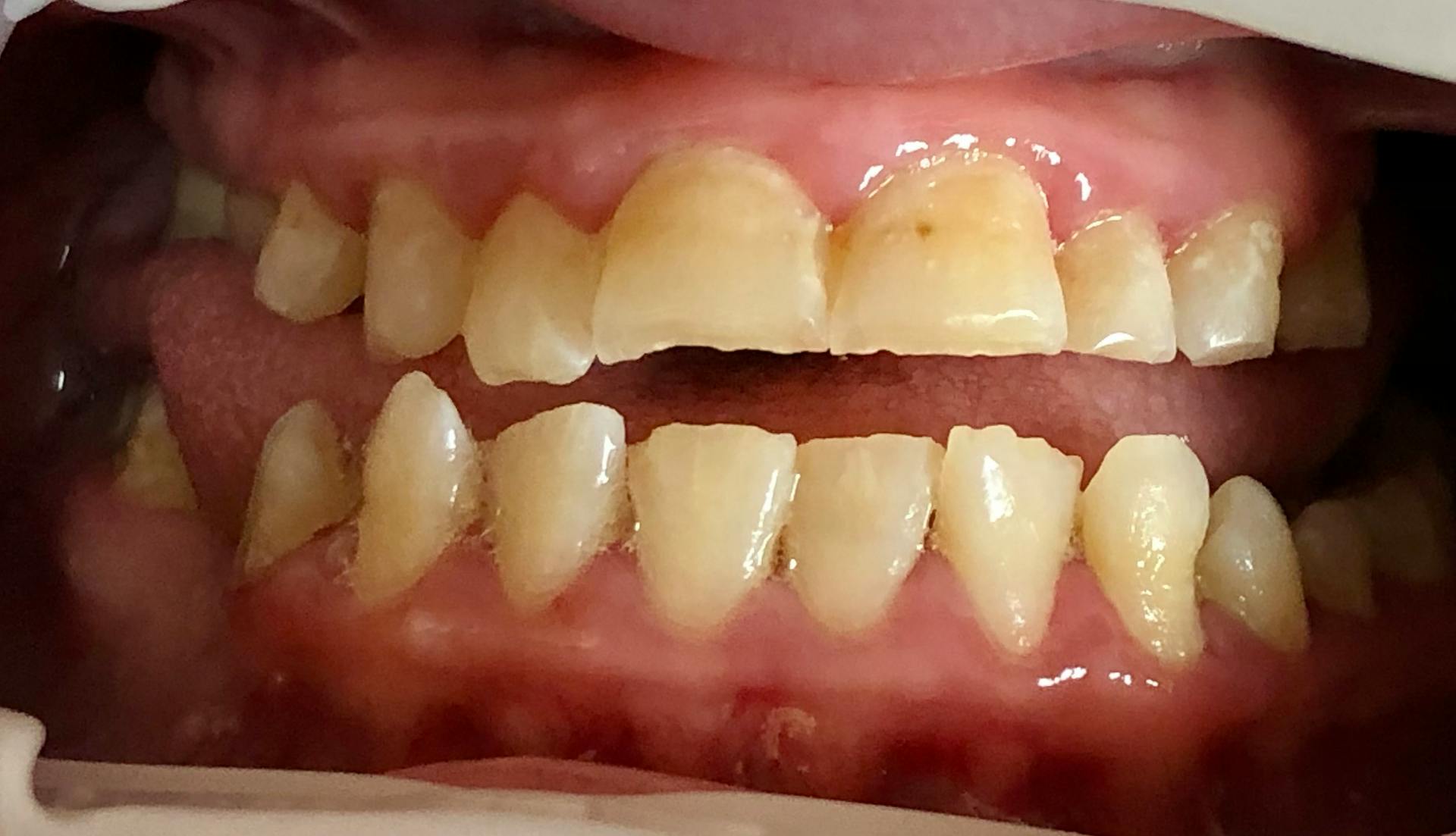 Figure 2: Katie has small fractures on her teeth.